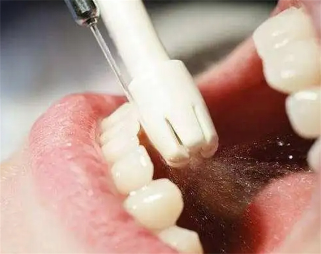 怎样去除牙结石不想洗牙